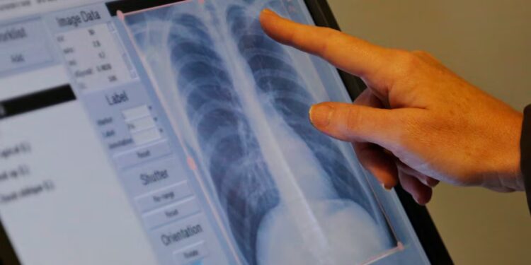 Tuberculosis-ataca-nl - Vecinos Unidos Crisis Sanitaria Por Letal Brote Bacteriano - Vecinos Unidos