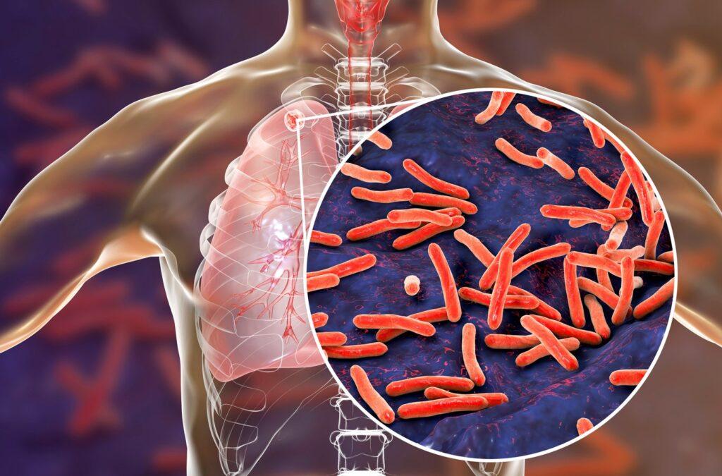 Tuberculosis-por-falta-de-medicamentos - Vecinos Unidos Tuberculosis En Nl Desata Grave Crisis Sanitaria - Vecinos Unidos